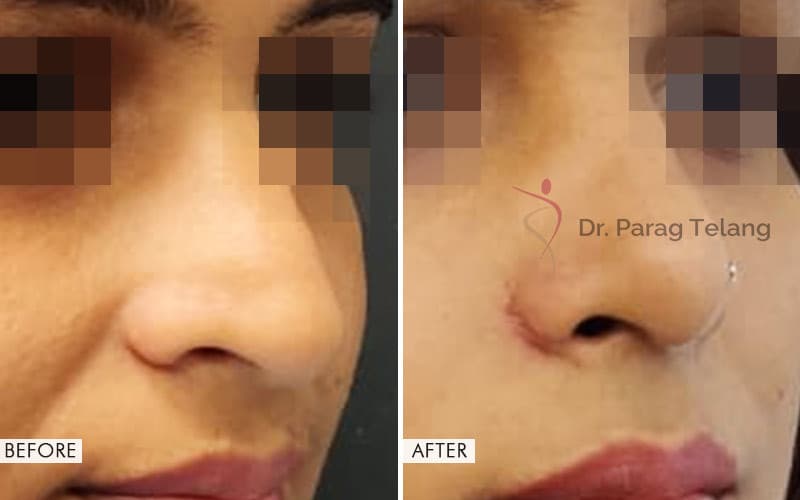 Rhinoplasty Surgery