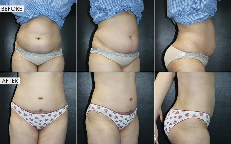 abdominoplasty surgery before and after