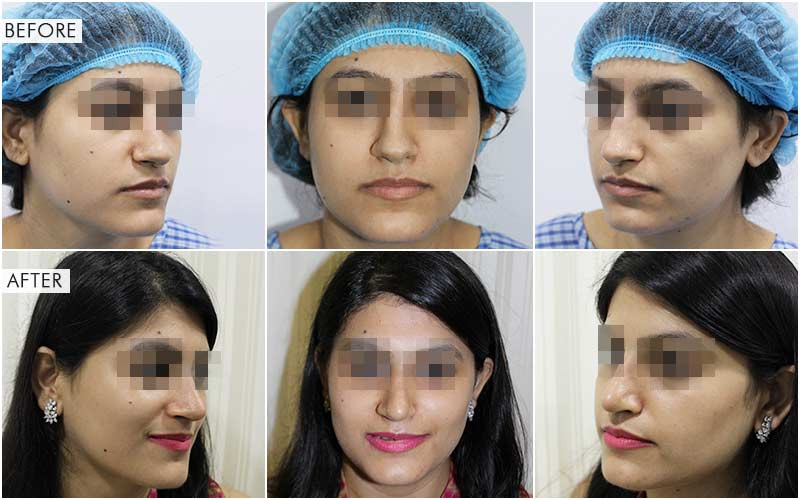 rhinoplasty surgery before and after