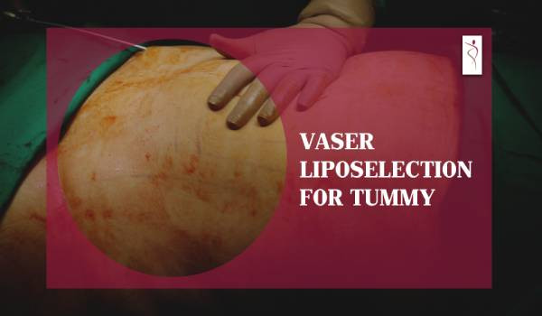 Vaser Liposelection for Tummy | Dr. Parag Telang