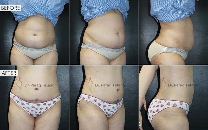 abdominoplasty surgery before and after