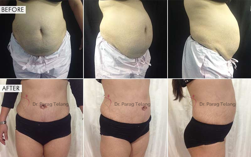 Abdominoplasty Surgery Before After