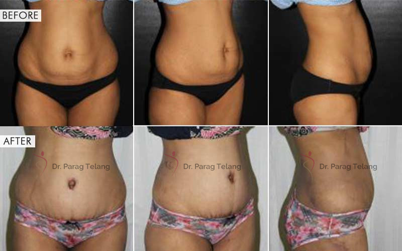 Abdominoplasty Surgery Before After