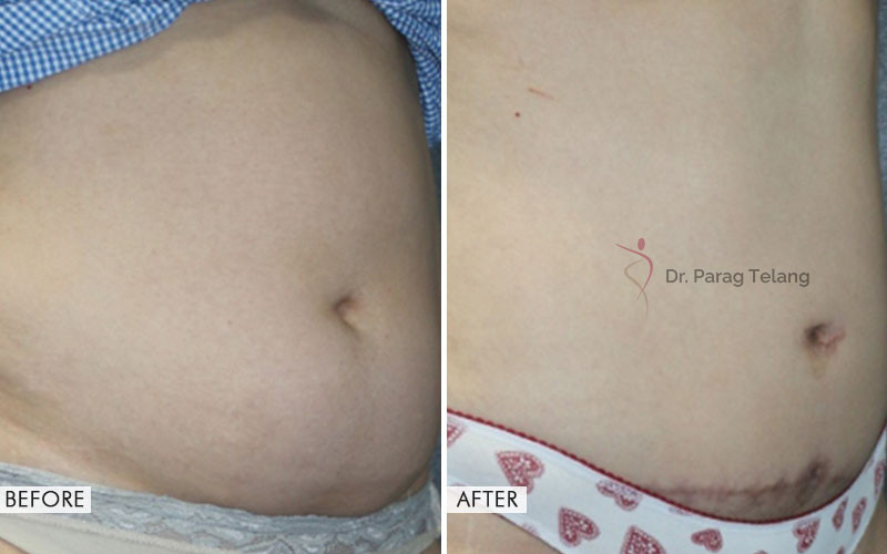 abdominoplasty before and after