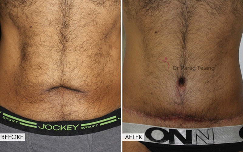 belt lipectomy before and after