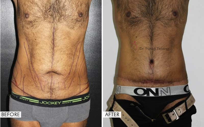 Belt Lipectomy Surgery Before After