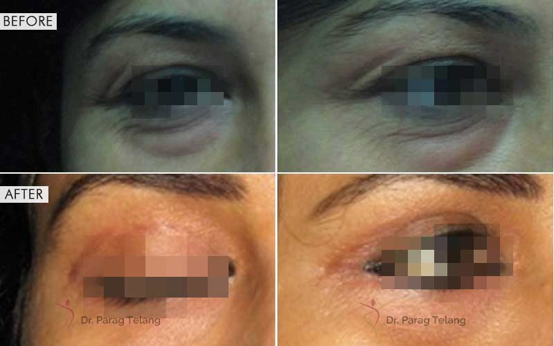 blepharoplasty surgery before and after