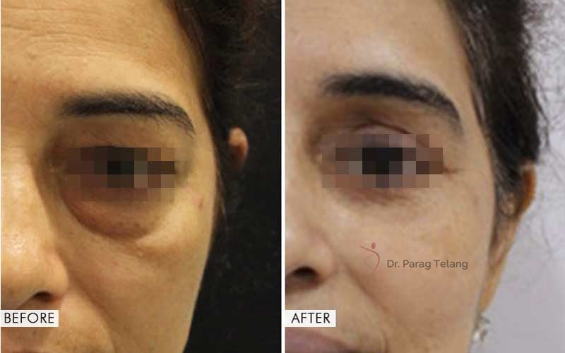 Blepharoplasty Surgery Before After