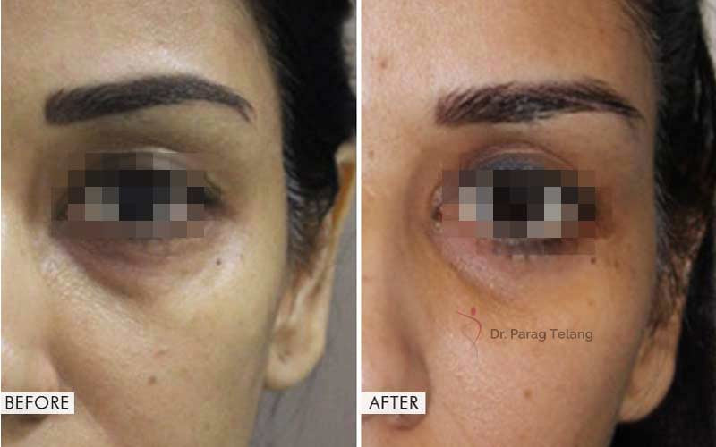 Blepharoplasty Surgery Before After