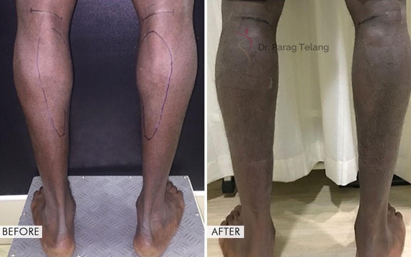 calf implant before and after