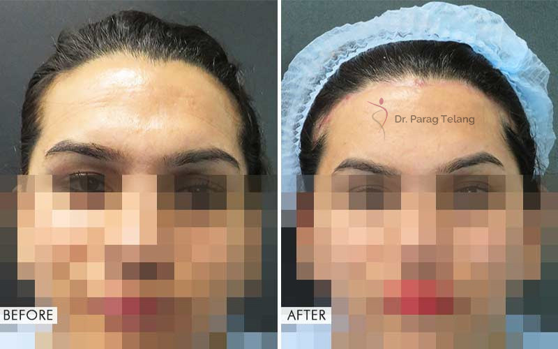 Forehead Contouring  Before After