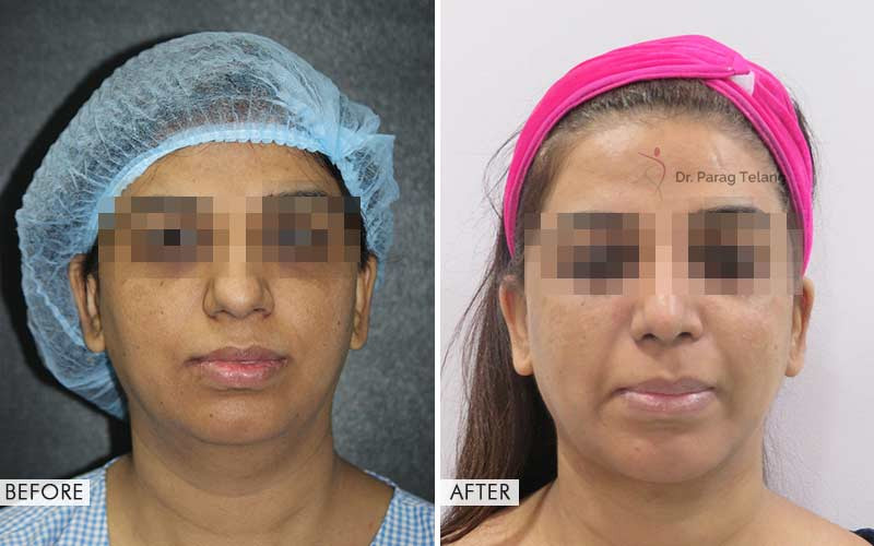 chin implant before and after