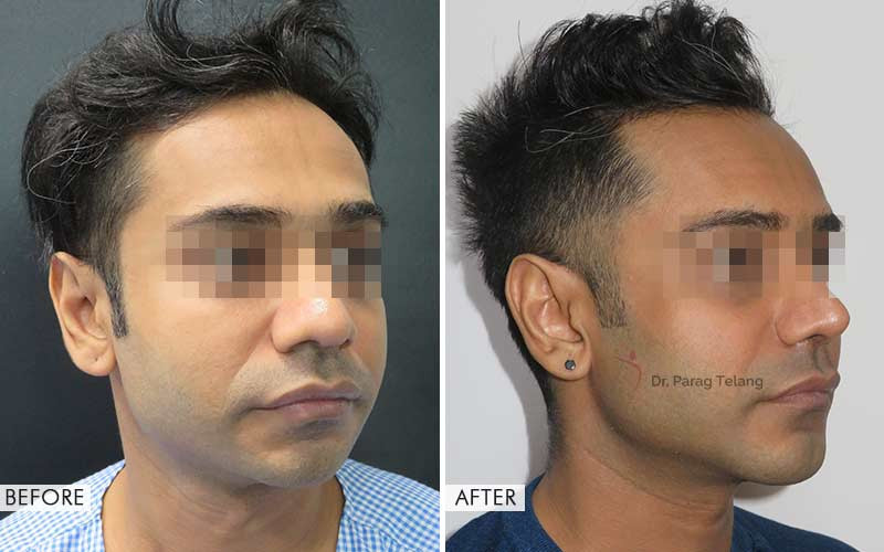 chin implant before and after