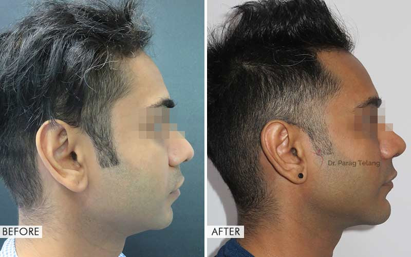 chin implant before and after