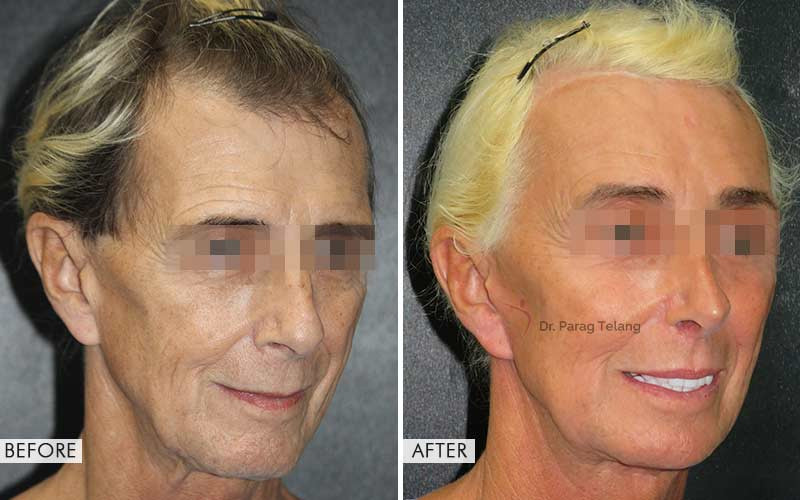 Facial Feminisation Surgery before and after