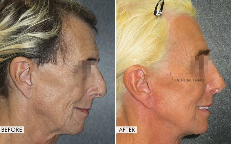 Facial Feminisation Surgery before and after