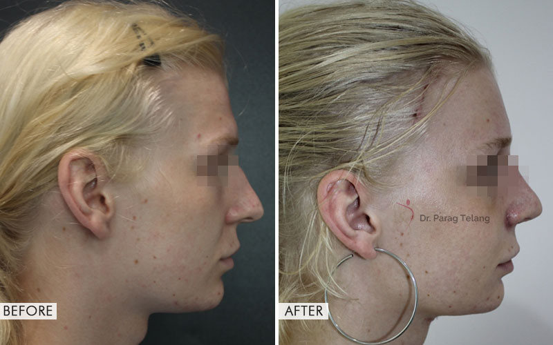 Facial Feminisation Surgery before and after