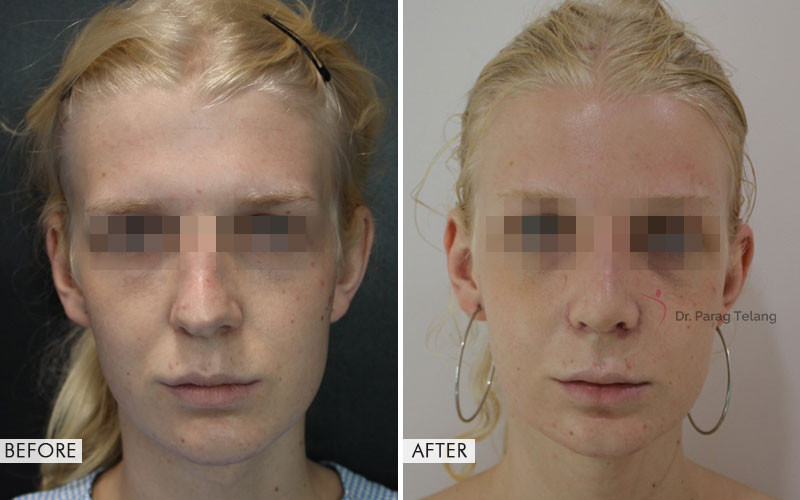 facial feminisation surgery before and after