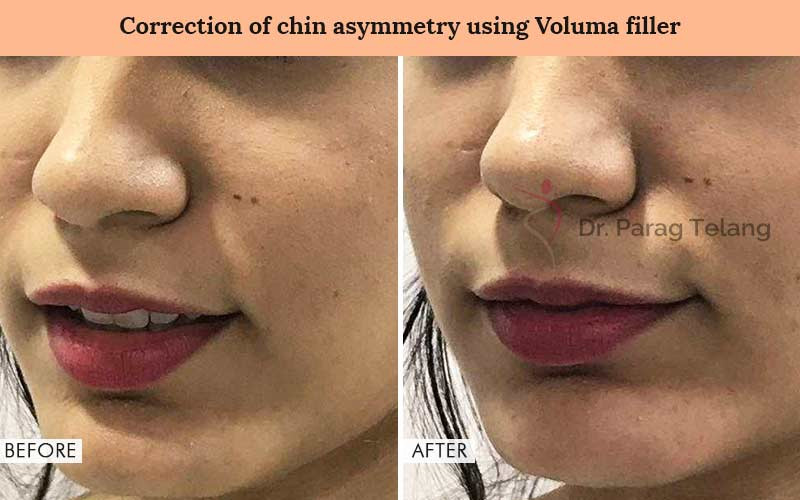 Correction of chin Asymmetry Before and After