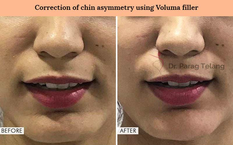 Correction of chin Asymmetry Before and After