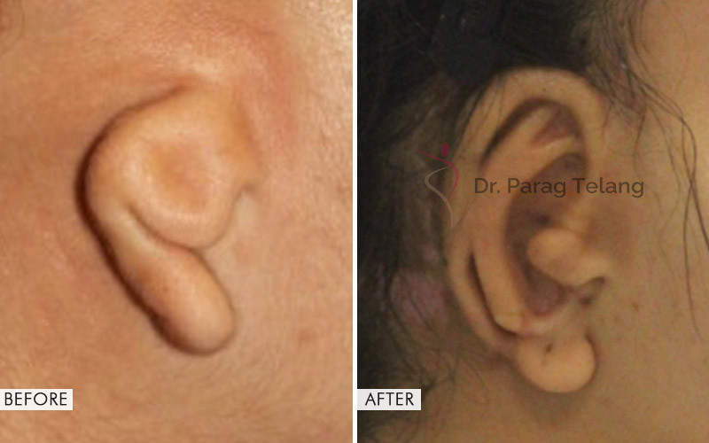 Ear Reconstruction Surgery Before and After