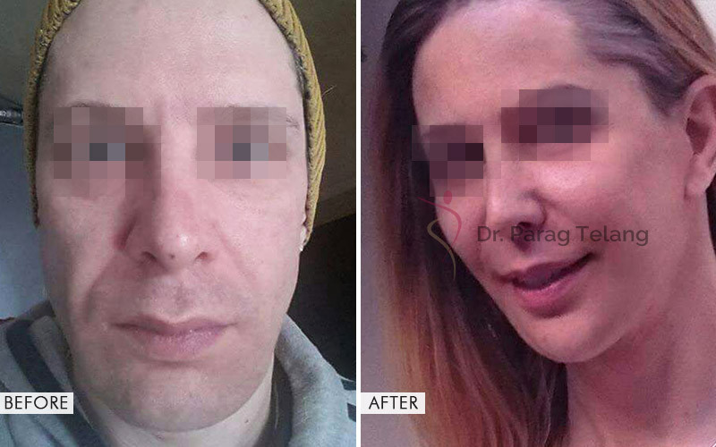 Facial Feminisation Surgery Before and After