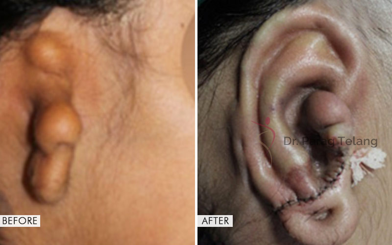 Ear-Reconstruction