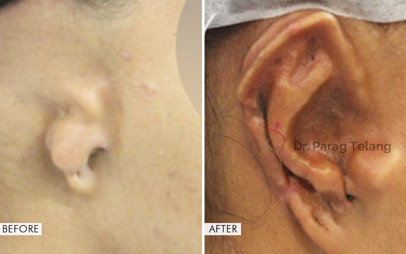Ear-Reconstruction