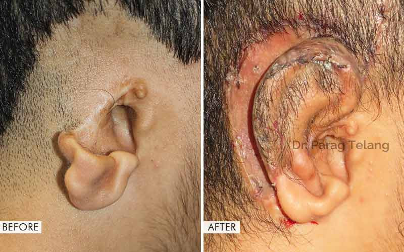 Ear-Reconstruction