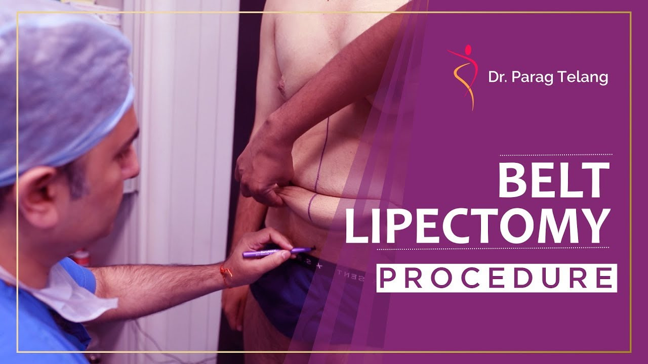 Belt Lipectomy Procedure