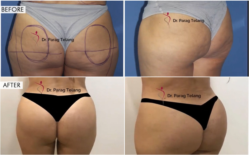 Butt Augmentation