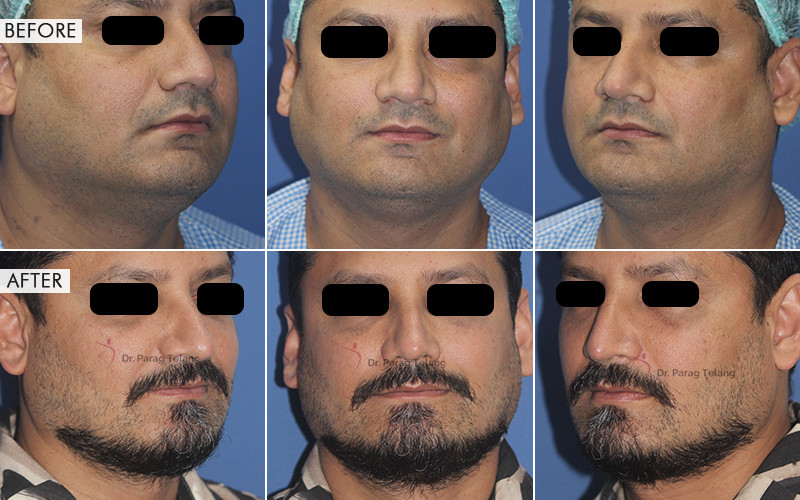 Facial Aesthetic Surgeries