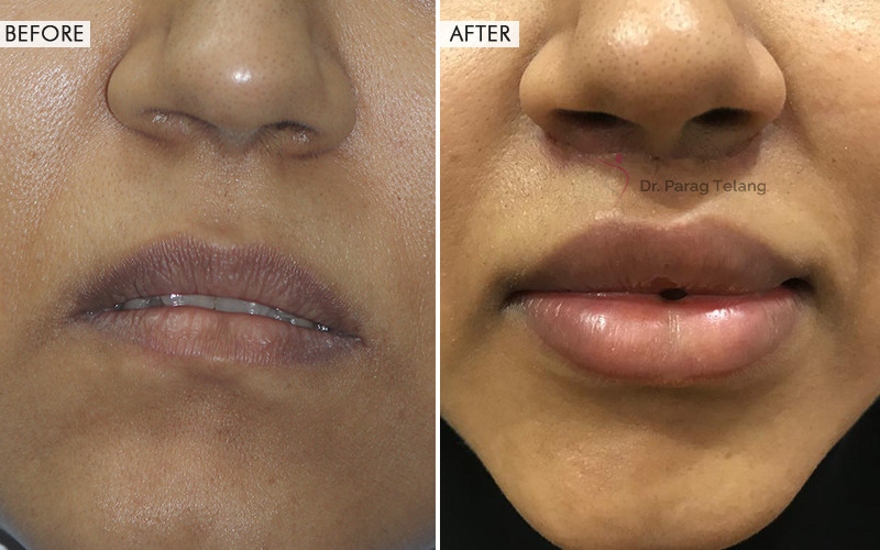 Lip Lift Surgery