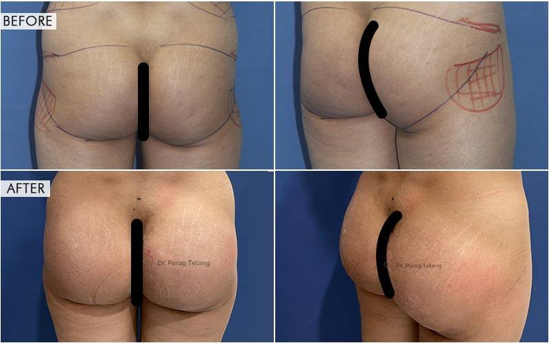 Butt Augmentation