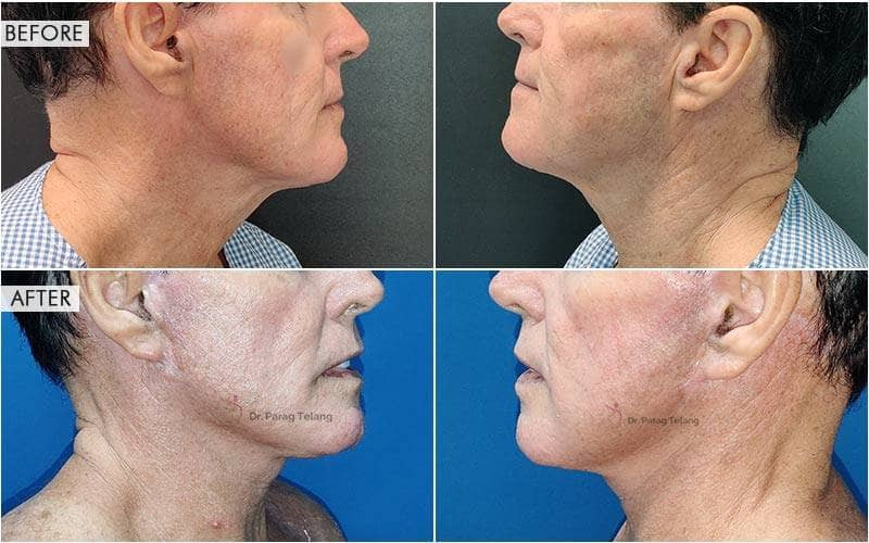 Face lift & neck lift