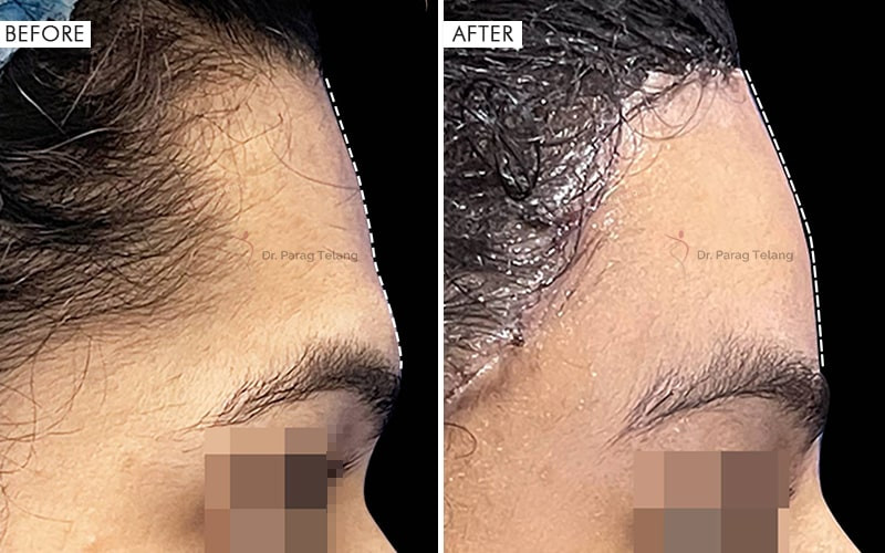 Type-3 Forehead Contouring (Brow Bone Reduction)