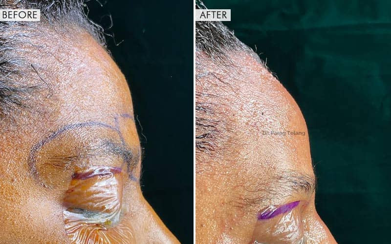 Type-3 Forehead Contouring (Brow Bone Reduction)