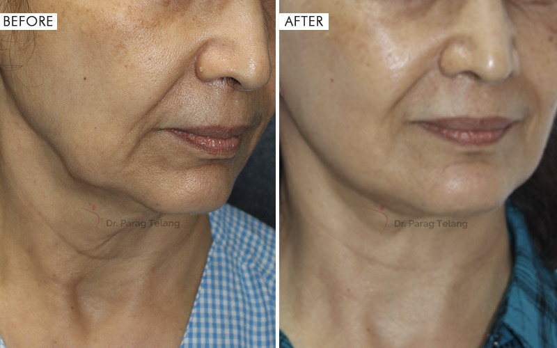 Jaw & Neck Contouring