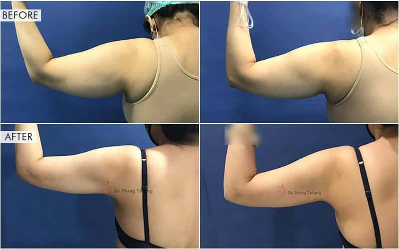 Arm Liposuction