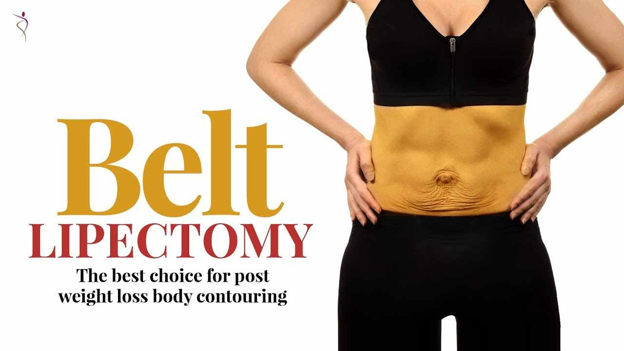 Belt Lipectomy: post weight loss body contouring procedure