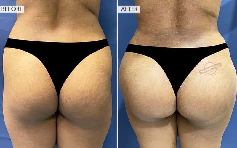 Butt Augmentation