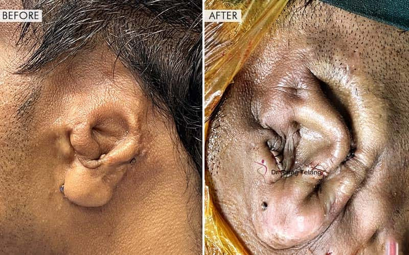 Ear Reconstruction