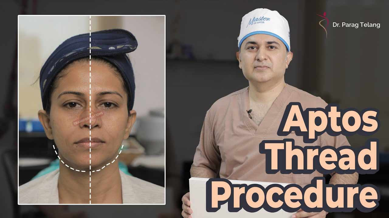 Non-Surgical Facelift Treatment | Aptos Threads Procedure & Results