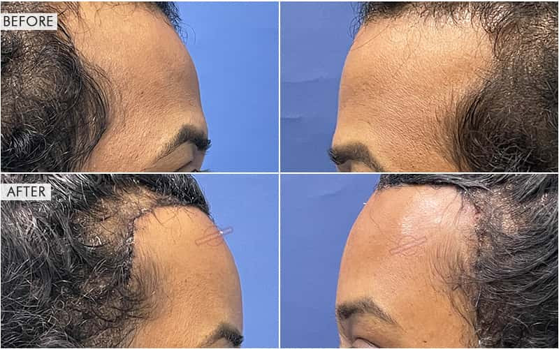 Forehead Contouring Before and After