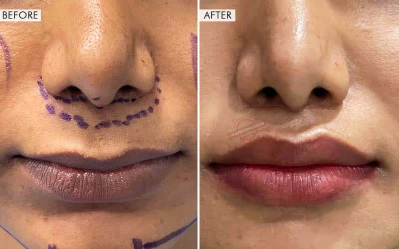 Lip Lift Surgery