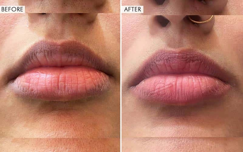 Lip Micropigmentation