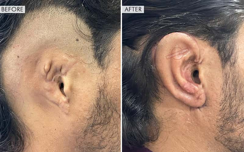 Ear Reconstruction