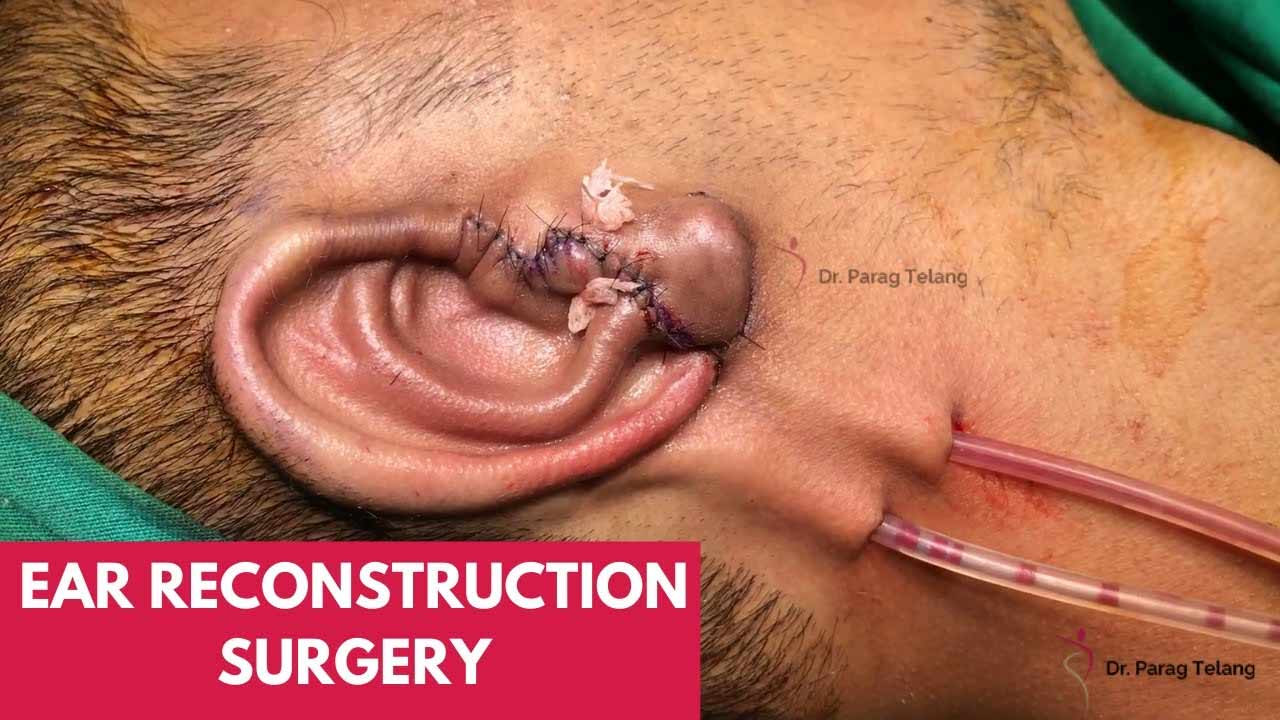 Microtia reconstruction