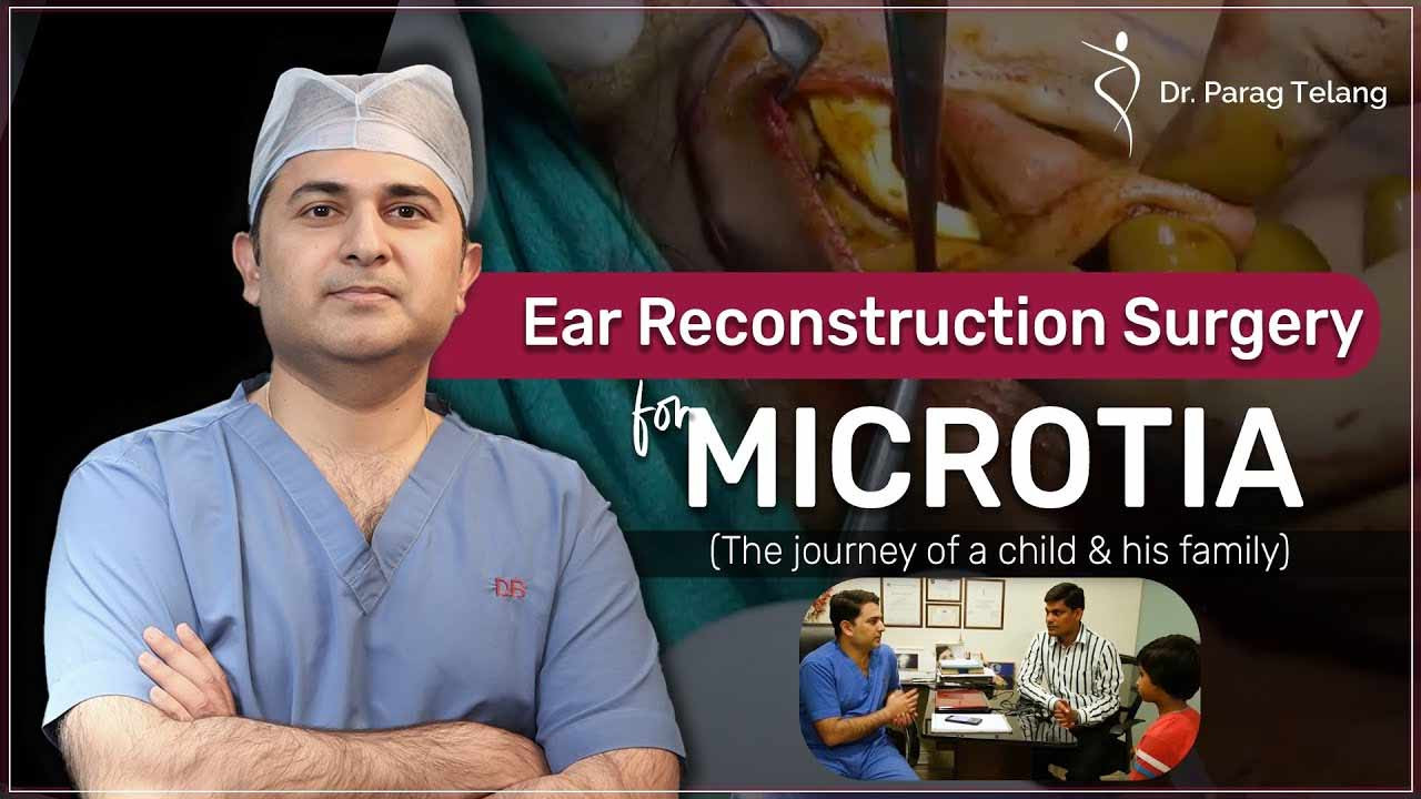 Microtia -Ear Creation/Reconstruction Surgery by Expert Dr. Parag Tela