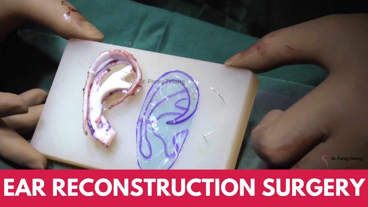 Ear Reconstruction Surgery for Microtia